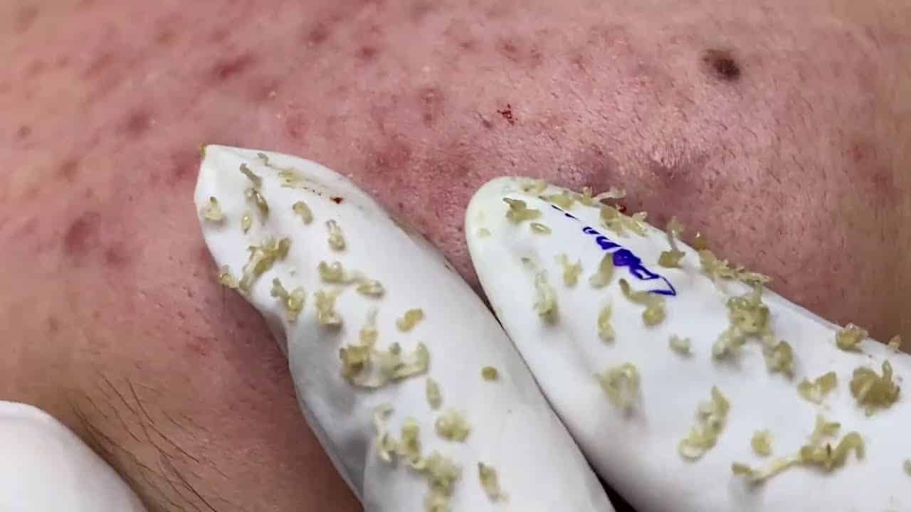 Blackheads extraction on face (n12)