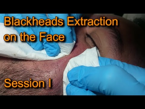Blackheads extraction on the Face Session I