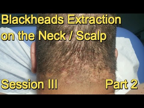 Blackheads Extraction on the Neck / Scalp –  Session III . Part 2
