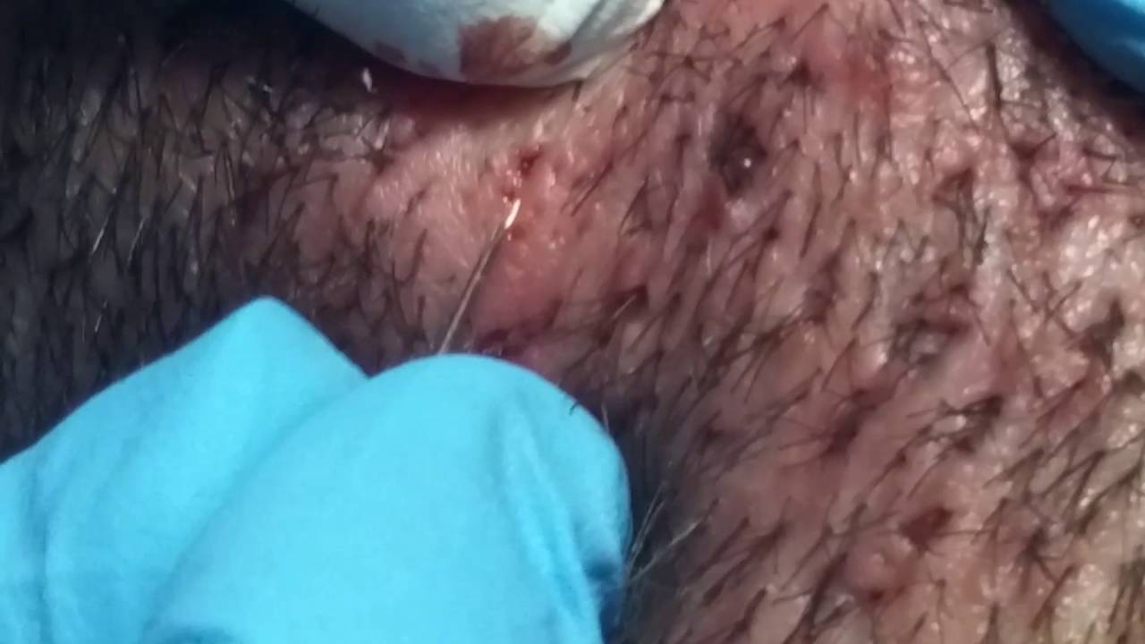 Blackheads Extraction on the Neck. Session II- Part 2