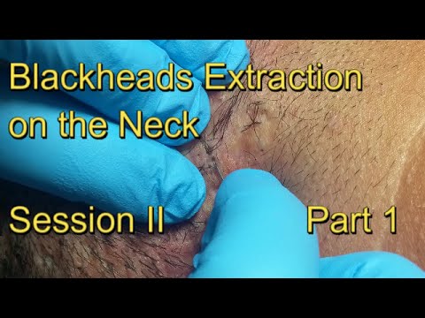 Blackheads Extraction on the Neck – Session II – Part 1