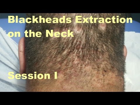 Blackheads Extraction on the Neck – Session 1. Deep Box-car Scars