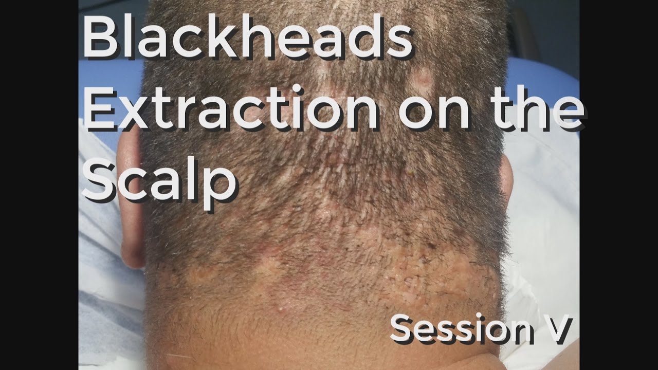 Blackheads Extraction on the Neck / Scalp – Session V