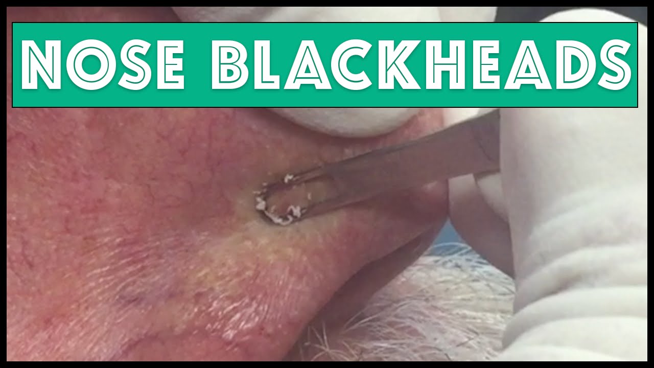 Blackheads Extraction on the nose