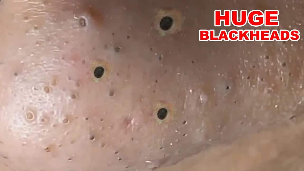 Blackheads Extraction On The Nose (part 1)