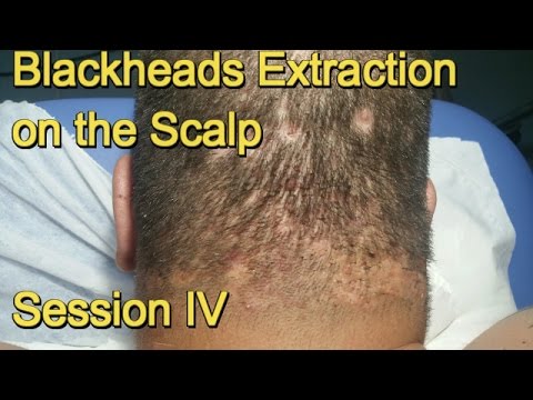Blackheads Extraction on the Scalp –  Session IV