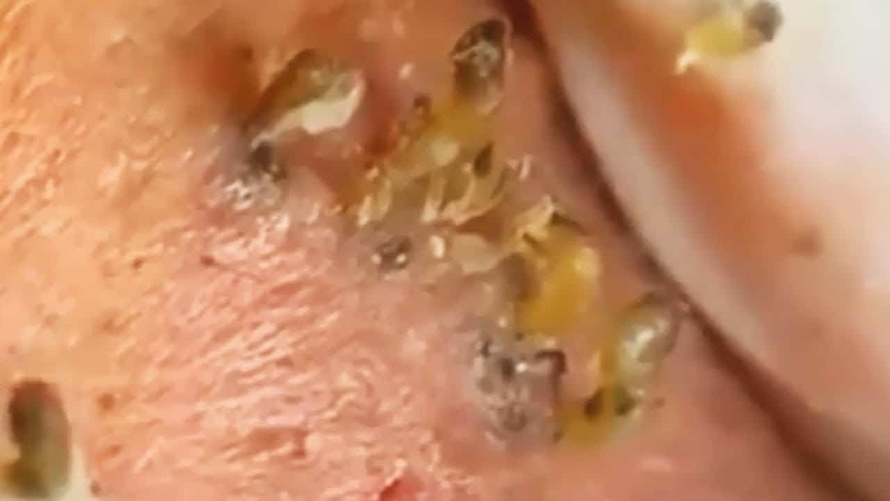 Blackheads Extraction Whiteheads Removal Pimple Popping #175