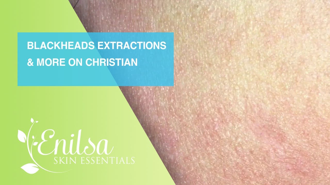 Blackheads Extractions and more on Christian