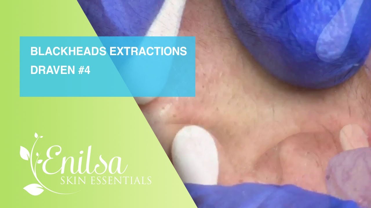Blackheads Extractions Draven 4th Treatment