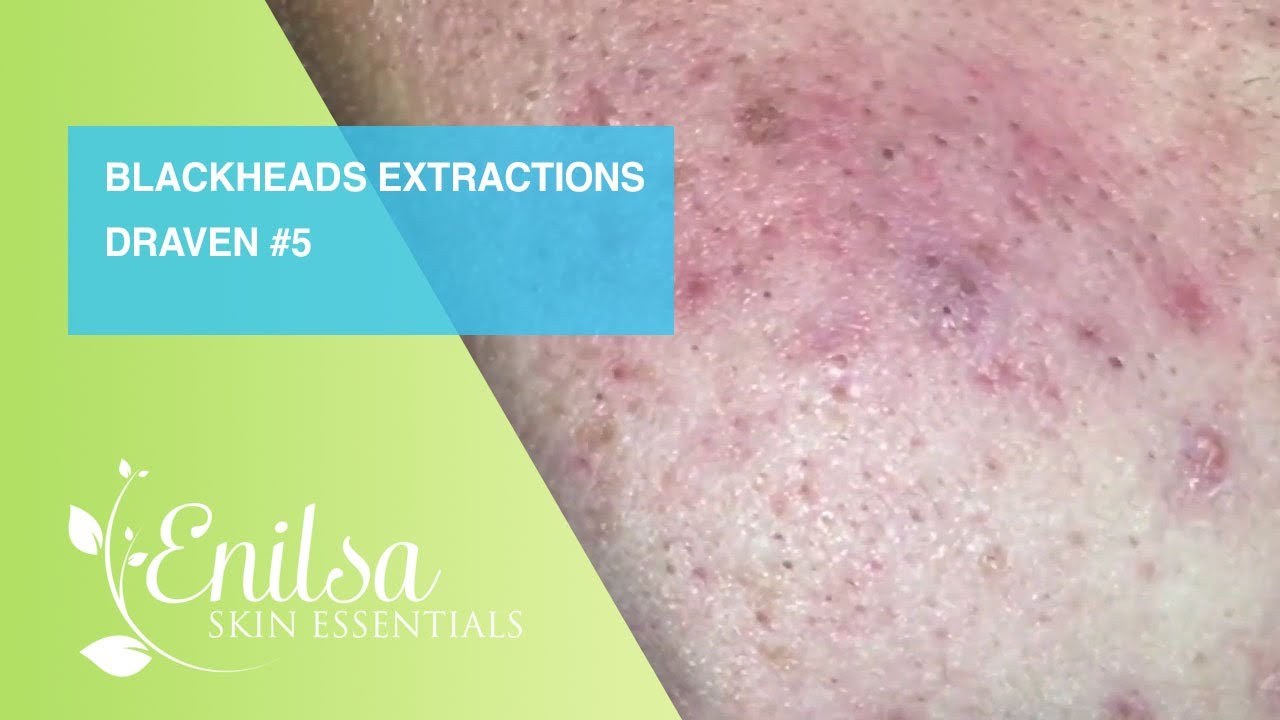 Blackheads Extractions Draven 5th Treatment