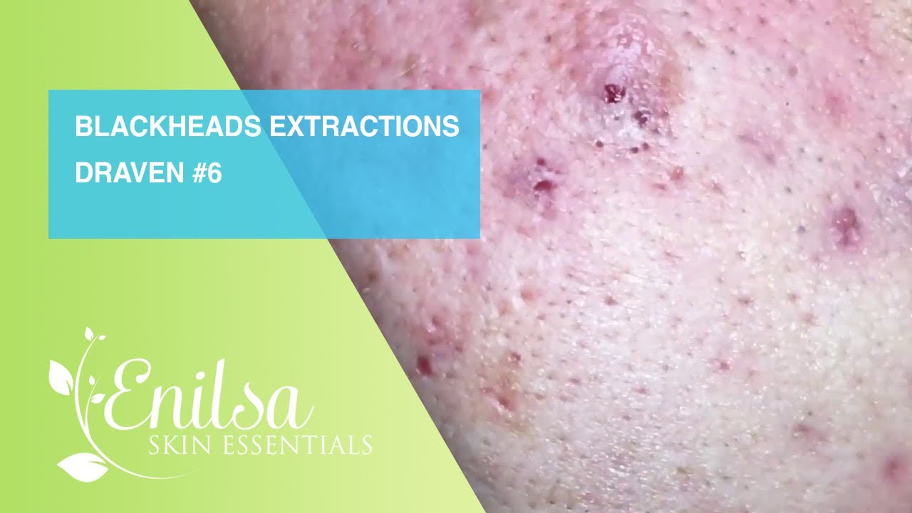 Blackheads Extractions Draven 6th Treatment