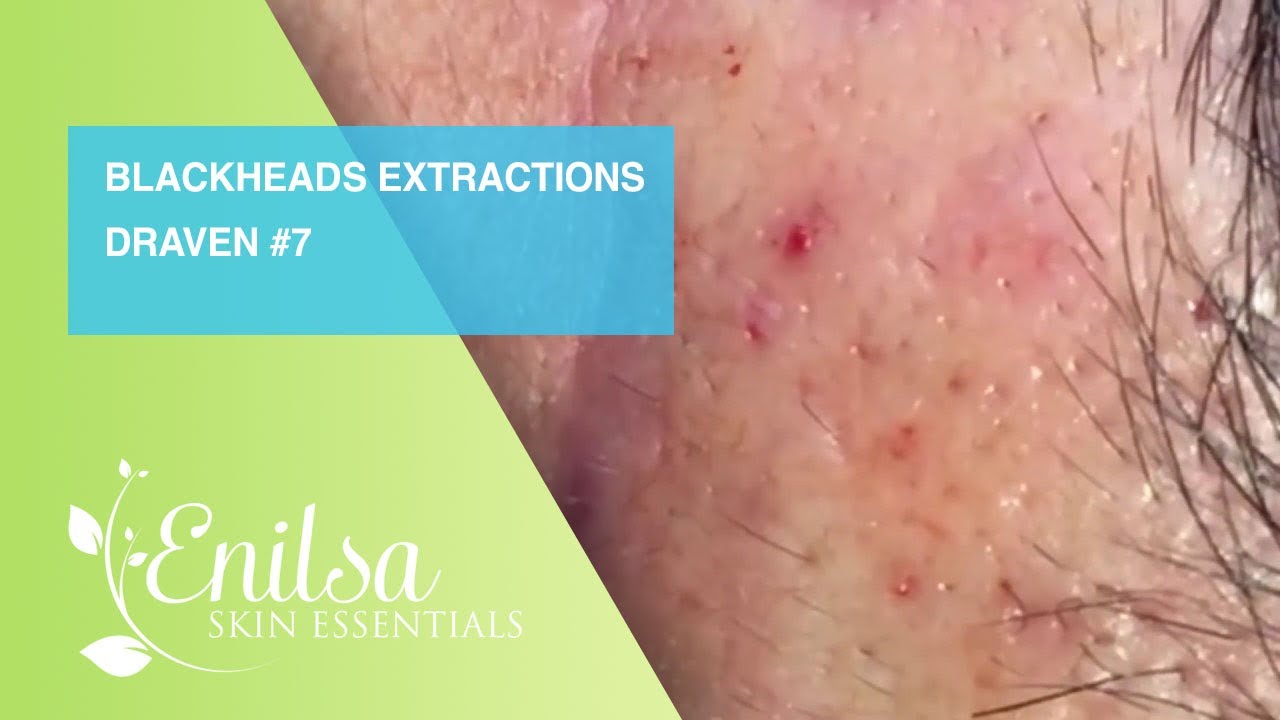 Blackheads Extractions Draven 7th Treatment