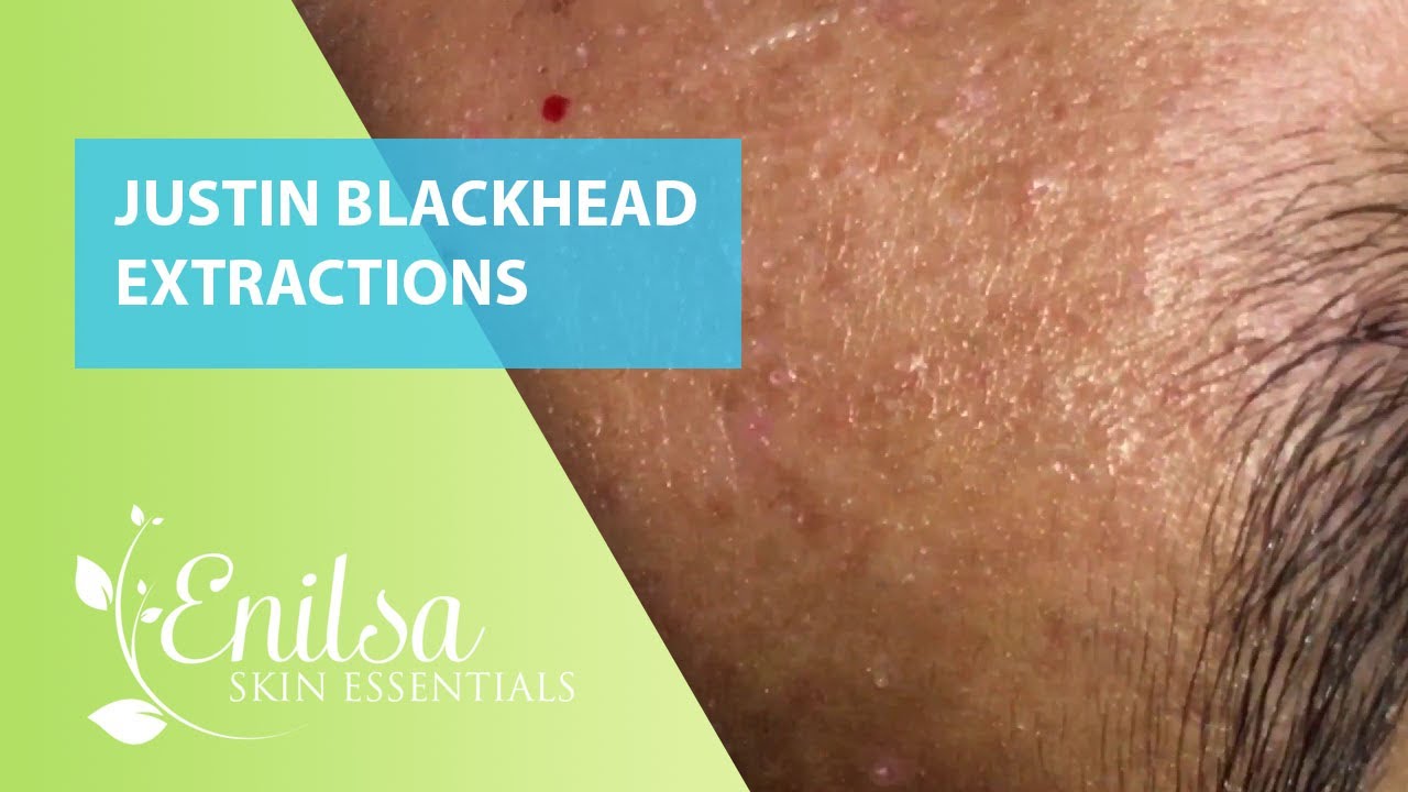 Blackheads Extractions Justin 2nd Treatment