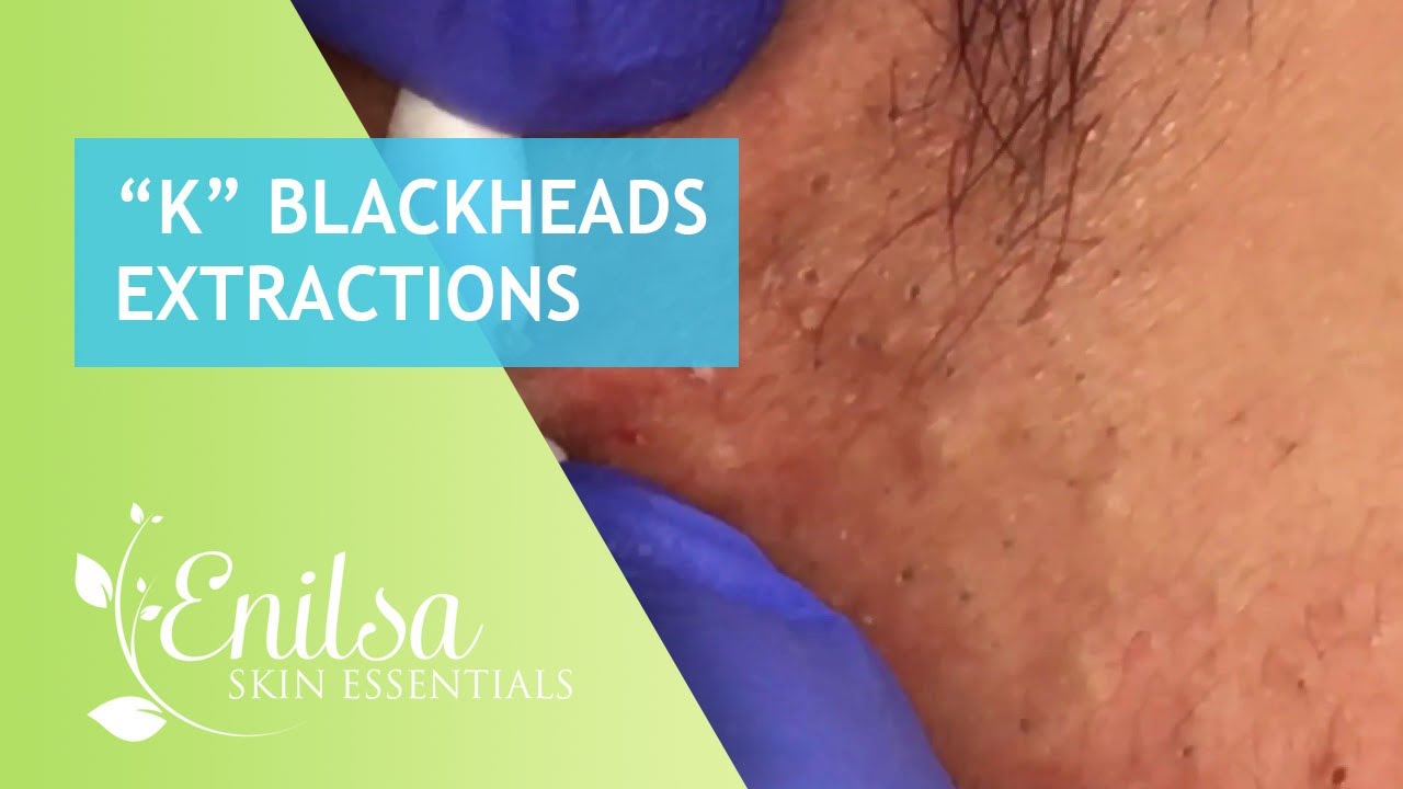 Blackheads Extractions “K’s” 2nd Treatment