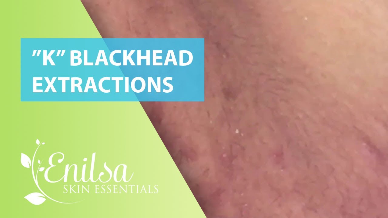 Blackheads Extractions “K’s” 5th Treatment
