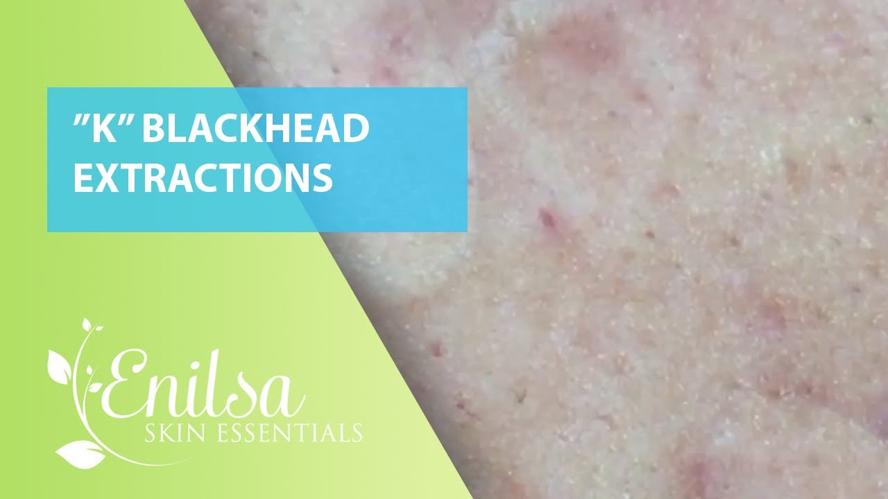 Blackheads Extractions “K’s” 6th Treatment