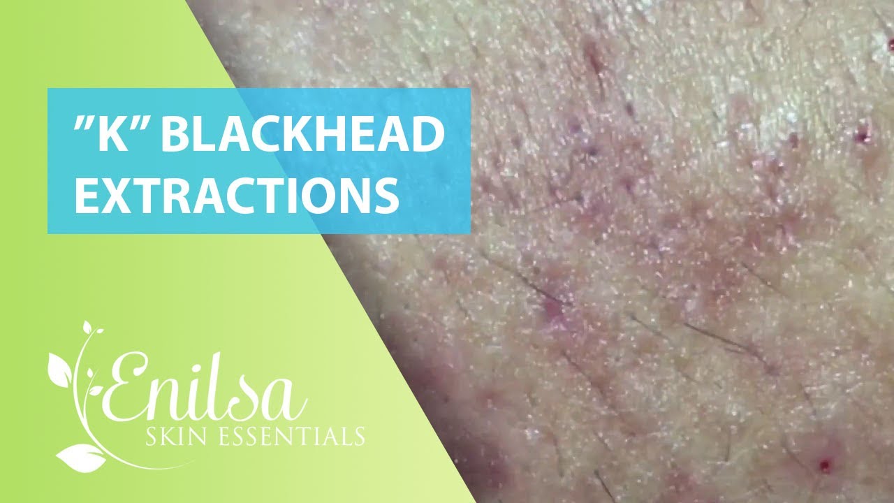 Blackheads Extractions “K’s” 7th Treatment