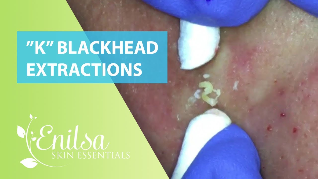 Blackheads Extractions “K’s” 8th Treatment