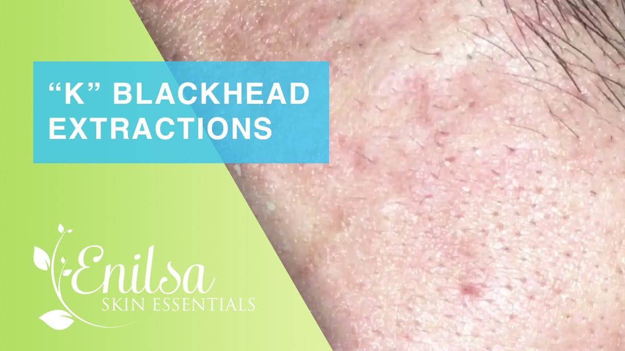 Blackheads Extractions “K’s” 8th Treatment Part 2