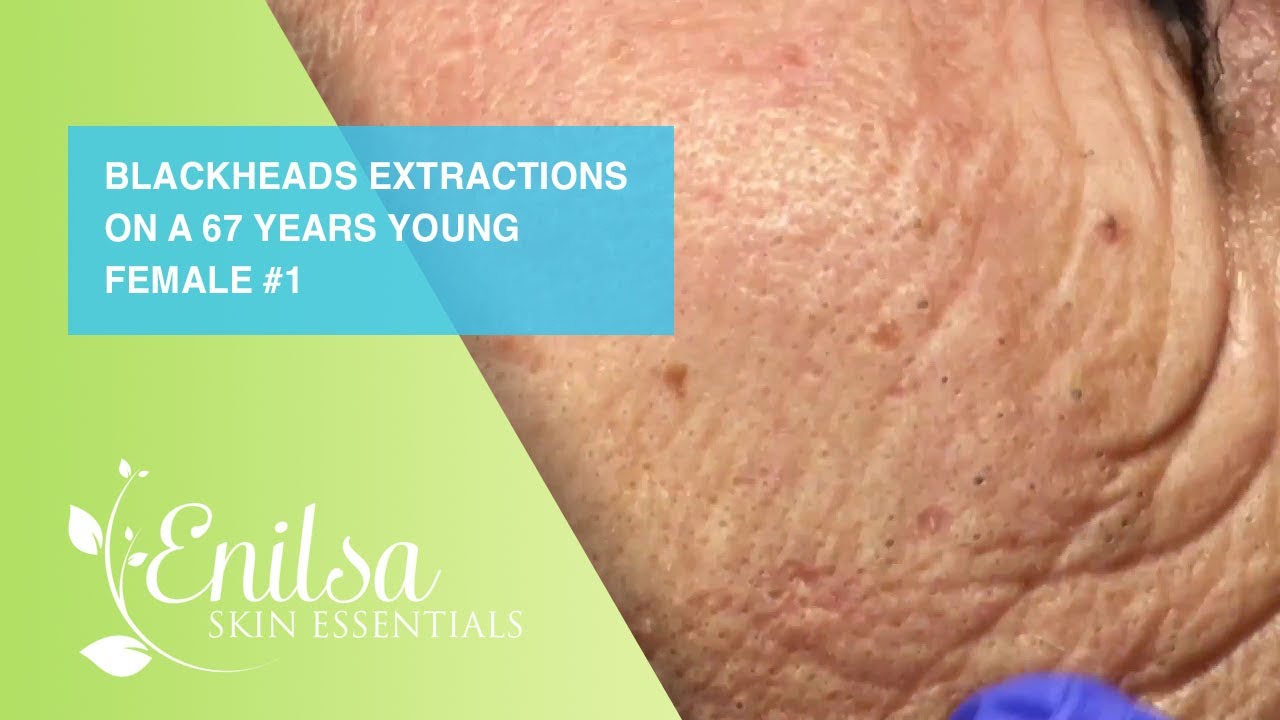 Blackheads Extractions on a 67 Years Young Female