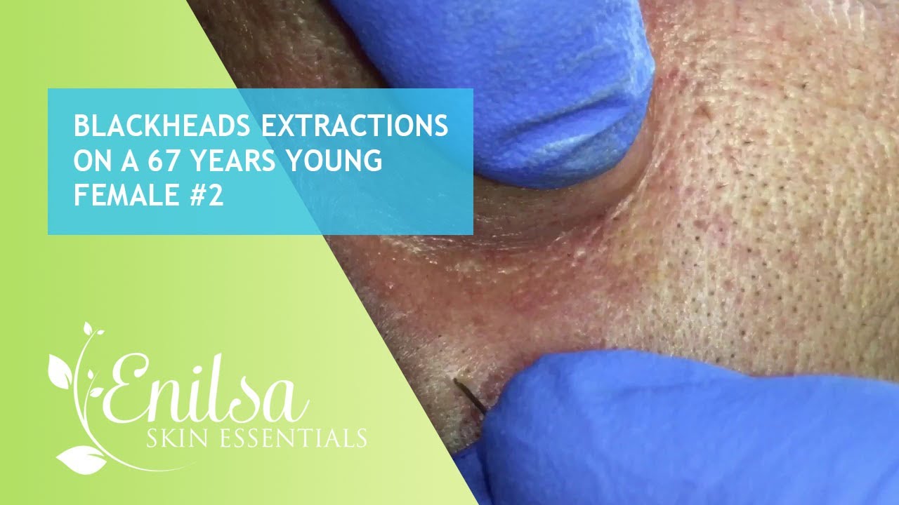 Blackheads Extractions on a 67 Years Young Female #2