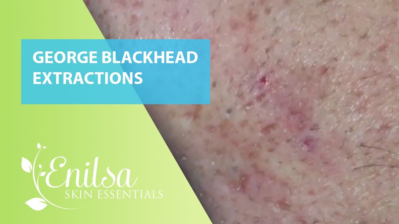 Blackheads Extractions on George