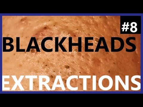 BLACKHEADS EXTRACTIONS on Happy :)- #8