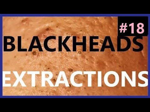 BLACKHEADS EXTRACTIONS on Happy #18