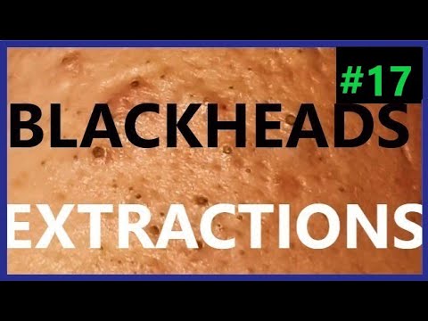 BLACKHEADS EXTRACTIONS on Happy #17