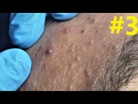 BLACKHEADS EXTRACTIONS  on  Happy’s Forehead #3
