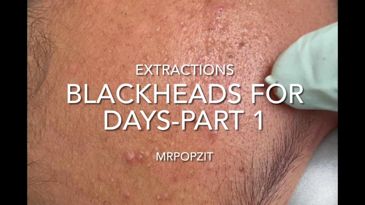 Blackheads for days part 1. 12 minutes of just the pop.acne extractions. Pimple popping.waxy plugs