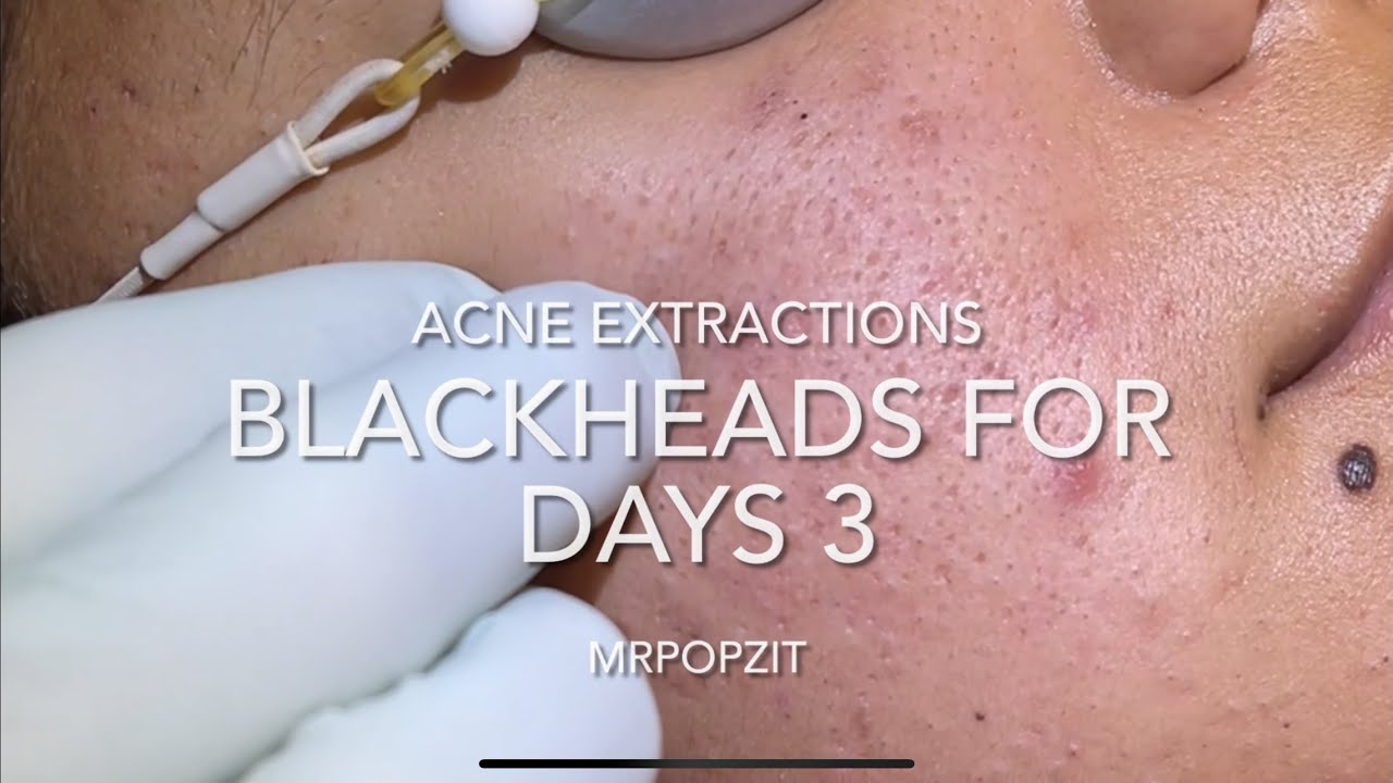 Blackheads for days part 3. 15 minutes of just the pop. Extractions. Blackheads, whiteheads, milia.