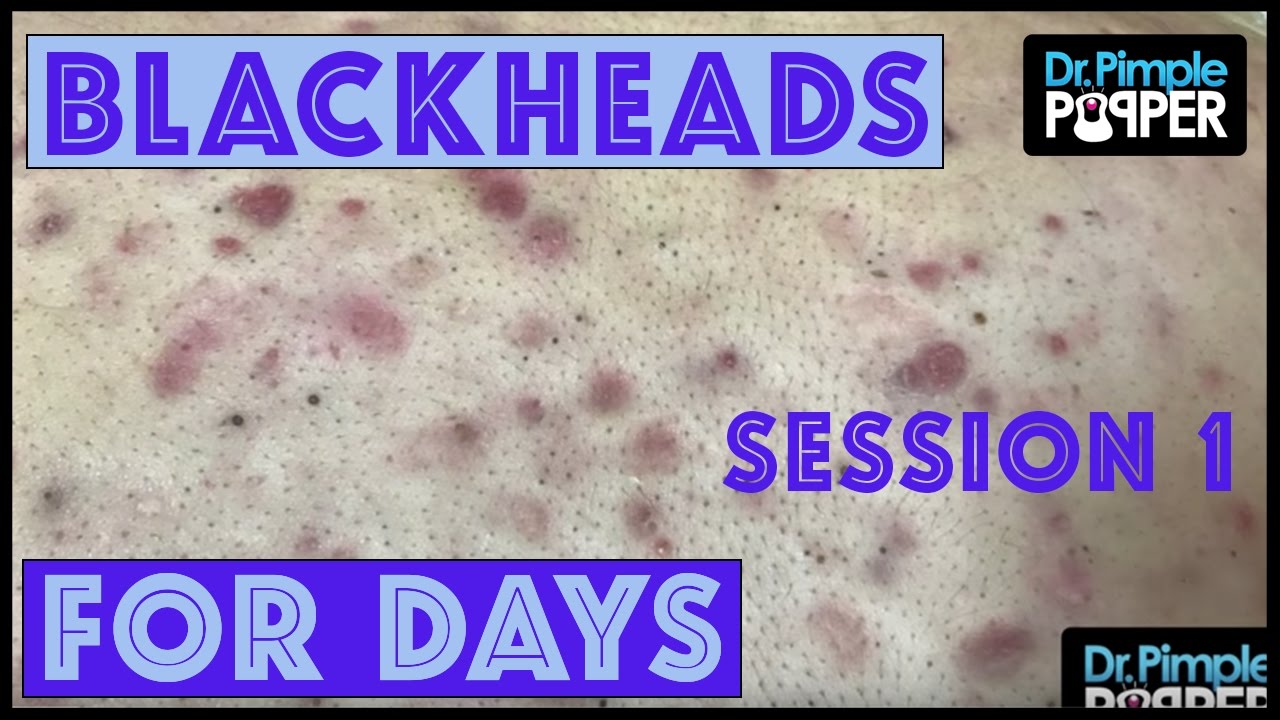 Blackheads for Dayzzzz with Dr Pimple Popper: Session 1