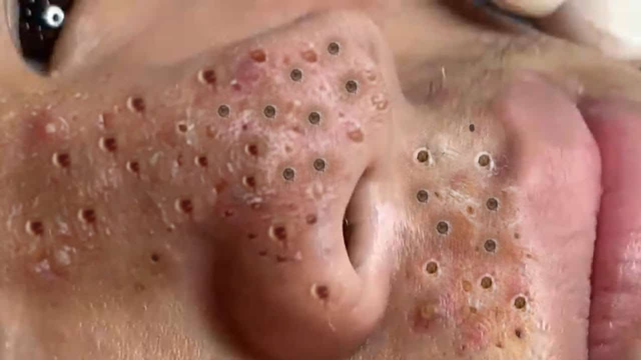 Blackheads, Hidden Acne on The Nose And On The Lips