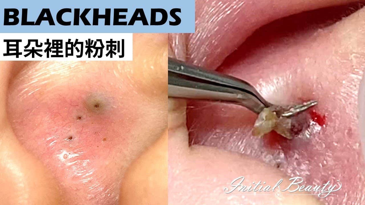 耳朵裡的黑頭(blackheads in ear) – Taiwan Tainan台南清粉刺最乾淨