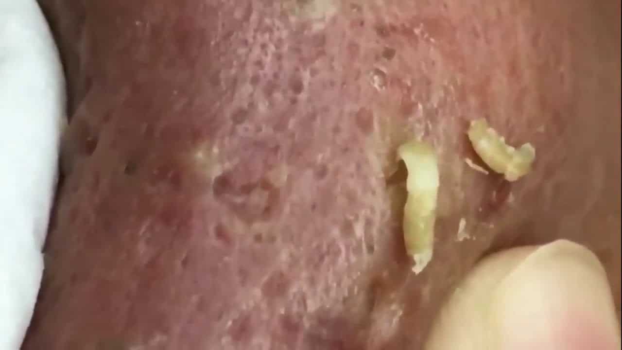 Blackheads    LARGE Blackheads Removal   Best Pimple Popping Videos #26