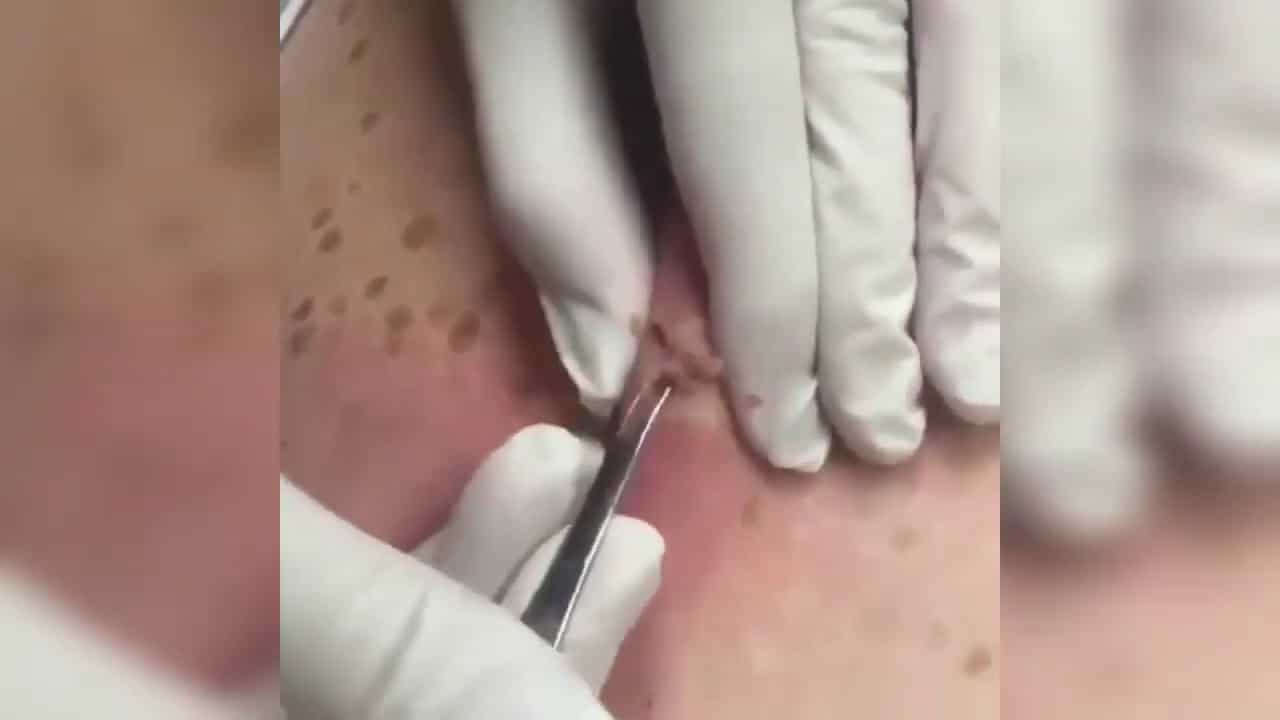 Blackheads    LARGE Blackheads Removal   Best Pimple Popping Videos #11