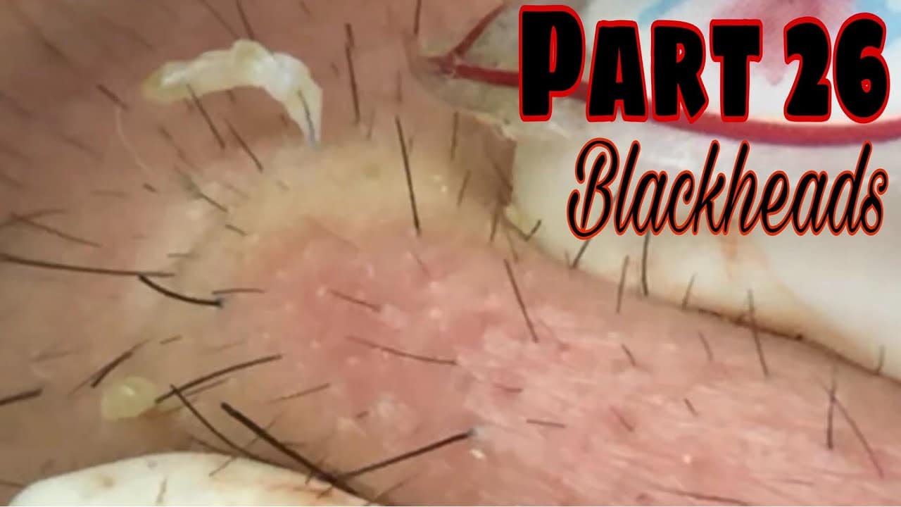 Blackheads + long acne, hidden deep under this guy's skin | PART 26 | B'Young Spa Quyet Hair