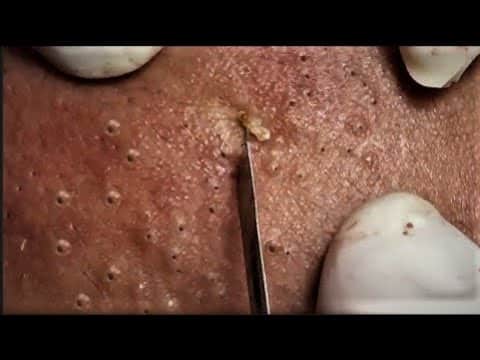 Blackheads & Milia, Big Cystic Acne Blackheads Extraction Whiteheads Removal Pimple Popping Part 61