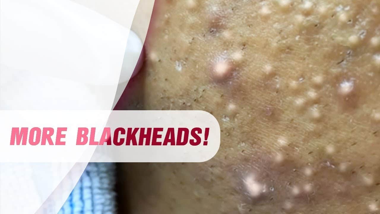 Blackheads & Milia, Big Cystic Acne Blackheads Extraction Whiteheads Removal Pimple Popping #63