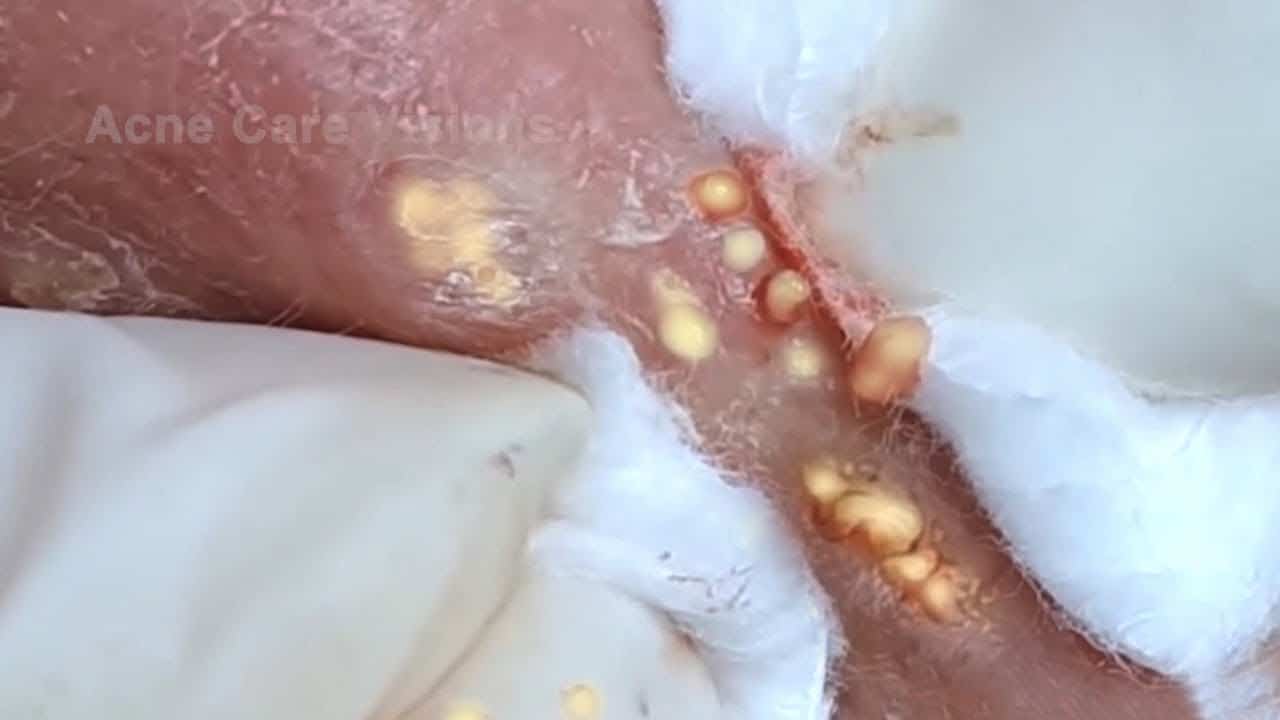 Blackheads & Milia, Big Cystic Acne Blackheads Extraction Whiteheads Removal Pimple Popping #56