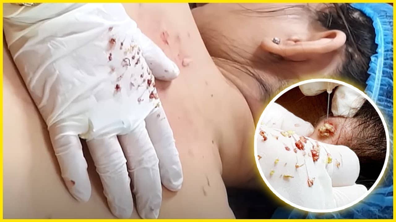 Blackheads & Milia, Big Cystic Acne Blackheads Extraction Whiteheads Removal Pimple Popping #48