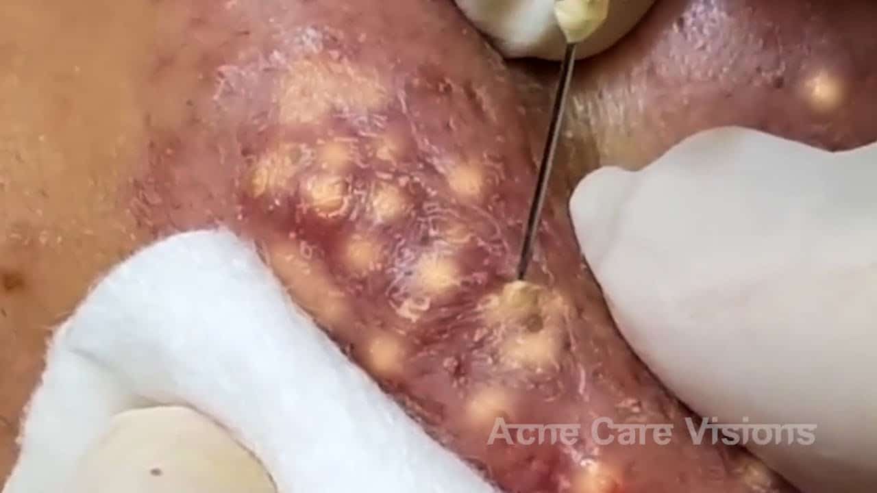 Blackheads & Milia, Big Cystic Acne Blackheads Extraction Whiteheads Removal Pimple Popping #46