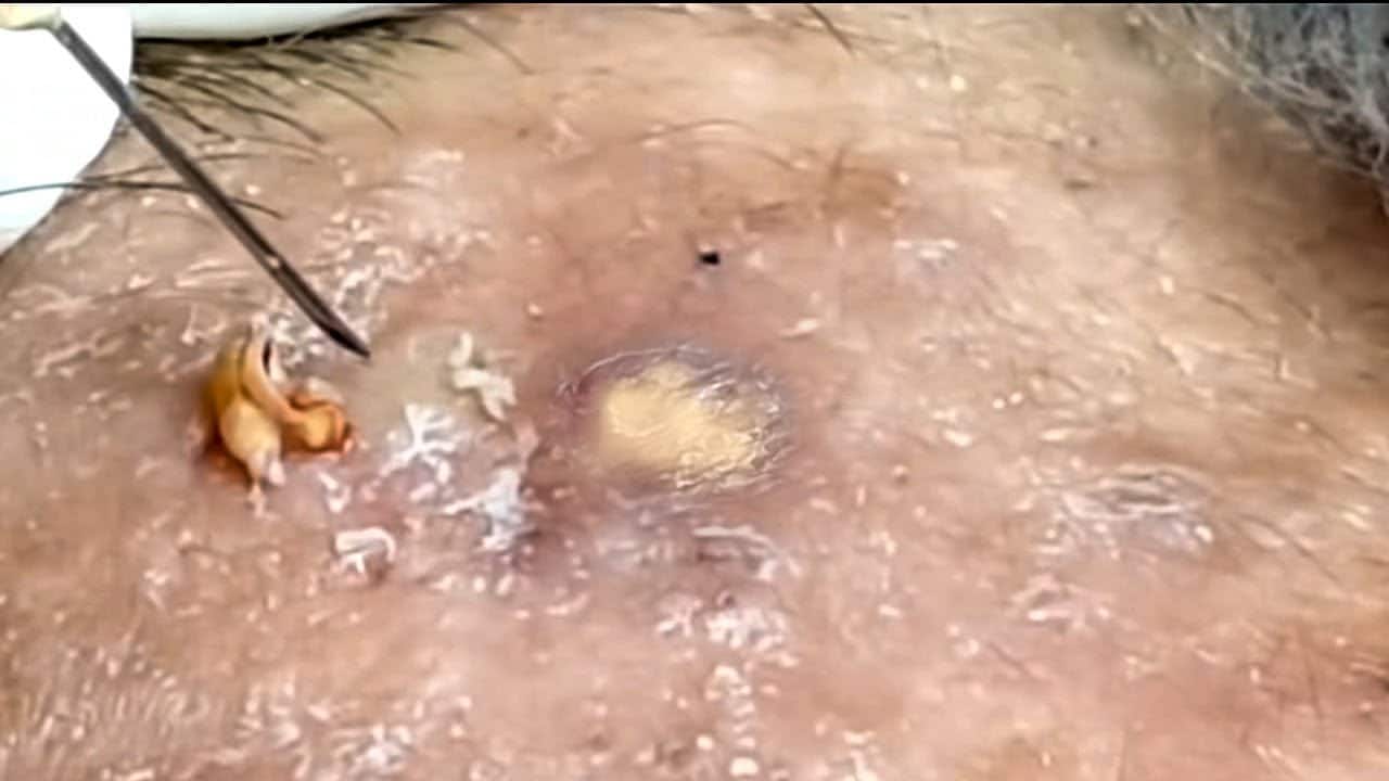 Blackheads & Milia, Big Cystic Acne Blackheads Extraction Whiteheads Removal Pimple Popping #45