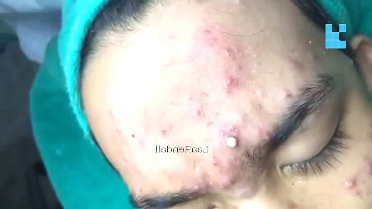 Blackheads & Milia, Big Cystic Acne Blackheads Extraction Whiteheads Removal Pimple Popping #6