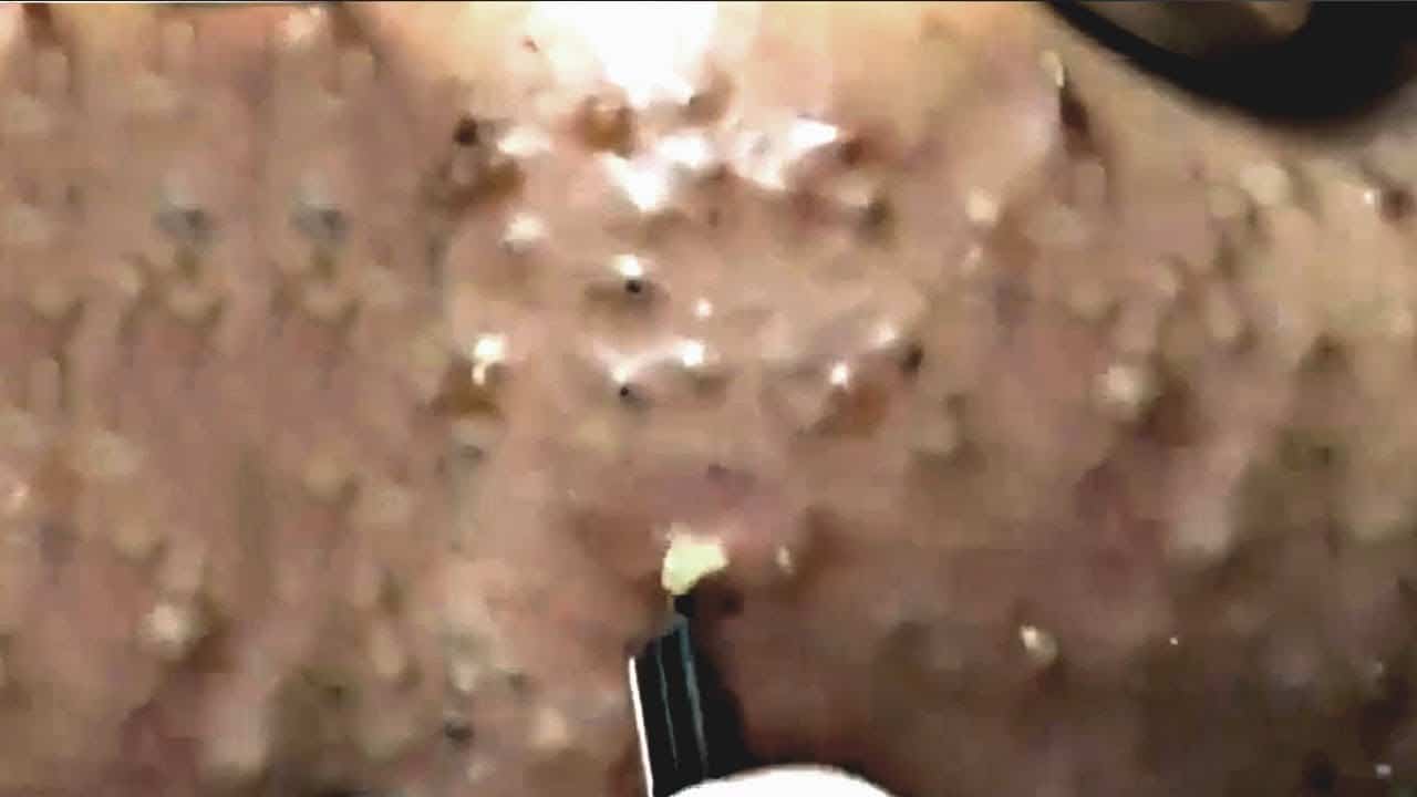 Blackheads & Milia, Big Cystic Acne Blackheads Extraction Whiteheads Removal Pimple Popping EP00#N6