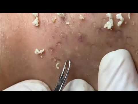 Blackheads & Milia, Big Cystic Acne Blackheads Extraction Whiteheads Removal Pimple Popping EP00A5