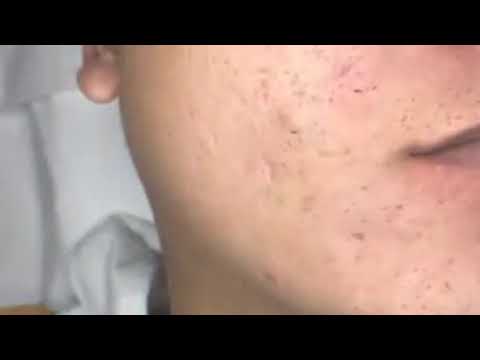 Blackheads & Milia, Big Cystic Acne Blackheads Extraction Whiteheads Removal Pimple Popping EP00#N3