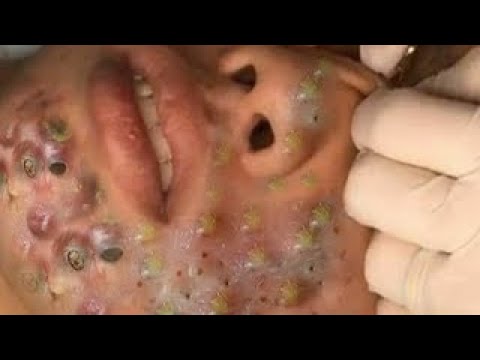 Blackheads & Milia, Big Cystic Acne Blackheads Extraction Whiteheads Removal Pimple Popping Part 57