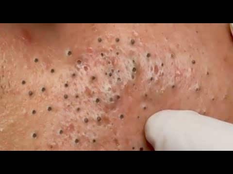 Blackheads & Milia, Big Cystic Acne Blackheads Extraction Whiteheads Removal Pimple Popping EP00A1